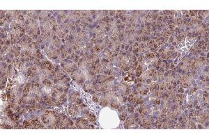 ABIN6273256 at 1/100 staining Human pancreas cancer tissue by IHC-P. (INSIG1 Antikörper  (Internal Region))