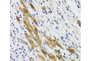 Immunohistochemistry of paraffin-embedded Human liver cancer using PLA2G2D Polyclonal Antibody at dilution of 1:100 (40x lens). (PLA2G2D Antikörper)