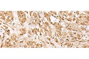Immunohistochemistry of paraffin-embedded Human breast cancer tissue using BAP1 Polyclonal Antibody at dilution of 1:35(x200) (BAP1 Antikörper)