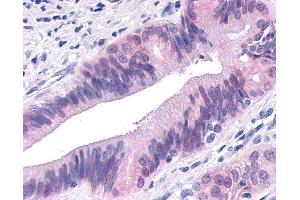 Anti-TNIK antibody IHC of human Pancreas, Carcinoma. (TNIK Antikörper  (Internal Region))