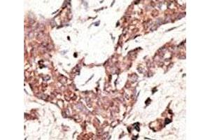 IHC analysis of FFPE human breast carcinoma tissue stained with the SIRT3 antibody (SIRT3 Antikörper  (AA 250-279))