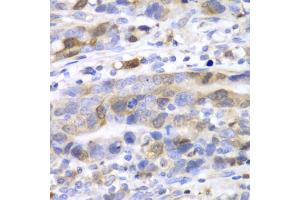 Immunohistochemistry of paraffin-embedded human gastric cancer using UBE2C antibody (ABIN5973207) at dilution of 1/100 (40x lens). (UBE2C Antikörper)