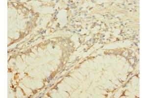 Immunohistochemistry of paraffin-embedded human colon cancer using ABIN7145384 at dilution of 1:100 (B4GALNT2 Antikörper  (AA 301-566))
