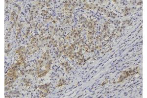 ABIN6278844 at 1/100 staining Human lung cancer tissue by IHC-P. (CRLF1 Antikörper)