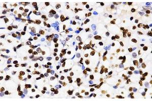 Immunohistochemistry of paraffin-embedded Human kidney cancer using DiMethyl-Histone H3-K4 Polyclonal Antibody at dilution of 1:200 (40x lens). (Histone 3 Antikörper  (2meLys4))