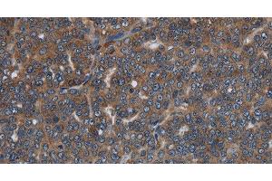 Immunohistochemistry of paraffin-embedded Human ovarian cancer tissue using LETMD1 Polyclonal Antibody at dilution 1:30 (LETMD1 Antikörper)