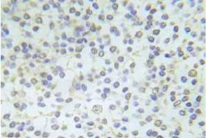 Immunohistochemistry (IHC) analyzes of p-Abl1 antibody in paraffin-embedded human breast carcinoma tissue. (ABL1 Antikörper  (pTyr204))