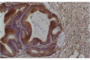Immunohistochemistry of paraffin-embedded Human colon carcinoma tissue using Smad3 Monoclonal Antibody at dilution of 1:200.
