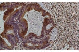 Immunohistochemistry of paraffin-embedded Human colon carcinoma tissue using Smad3 Monoclonal Antibody at dilution of 1:200. (SMAD3 Antikörper)