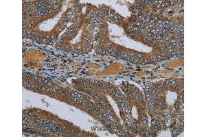 Immunohistochemistry of Human colon cancer using PCK2 Polyclonal Antibody at dilution of 1:60 (PEPCK Antikörper)