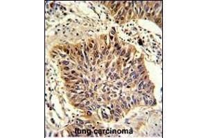 Formalin-fixed and paraffin-embedded human lung carcinoma with GOLPH3 Antibody (C-term), which was peroxidase-conjugated to the secondary antibody, followed by DAB staining.