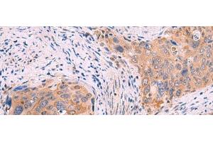 Immunohistochemistry of paraffin-embedded Human cervical cancer tissue using GSPT2 Polyclonal Antibody at dilution of 1:50(x200)
