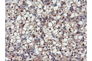 Immunohistochemical staining of paraffin-embedded Carcinoma of Human kidney tissue using anti-DPP9 mouse monoclonal antibody. (DPP9 Antikörper)