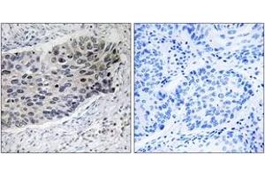 Immunohistochemistry analysis of paraffin-embedded human lung carcinoma tissue, using PC Antibody. (PC (AA 357-406) Antikörper)