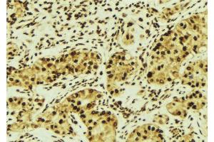 ABIN6276603 at 1/100 staining Human breast cancer tissue by IHC-P. (RASSF1 Antikörper  (Internal Region))