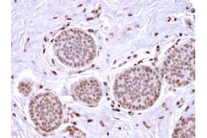 Formalin-fixed, paraffin-embedded human Breast Carcinoma stained with Mammaglobin Recombinant Rabbit Monoclonal Antibody (MGB1/2682R).