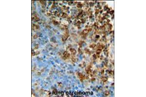 ITPA Antibody immunohistochemistry analysis in formalin fixed and paraffin embedded human lung carcinoma followed by peroxidase conjugation of the secondary antibody and DAB staining. (ITPA Antikörper  (N-Term))
