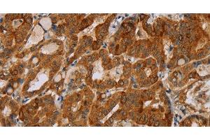 Immunohistochemistry of paraffin-embedded Human thyroid cancer tissue using MTUS1 Polyclonal Antibody at dilution 1:40 (MTUS1 Antikörper)
