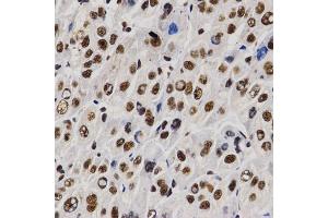 Immunohistochemistry of paraffin-embedded human liver cancer using PELP1 antibody (ABIN6292223) at dilution of 1:200 (40x lens). (PELP1 Antikörper)