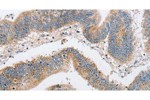 Immunohistochemistry of paraffin-embedded Human colon cancer using ARHGEF9 Polyclonal Antibody at dilution of 1:50