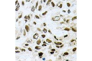 Immunohistochemical analysis of SAP145 staining in human lung cancer formalin fixed paraffin embedded tissue section.