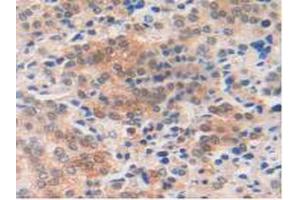IHC-P analysis of Human Prostate Gland Cancer Tissue, with DAB staining. (MIF Antikörper  (AA 3-111))