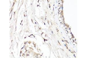 Immunohistochemistry of paraffin-embedded Human breast using CDK7 Polyclonal Antibody at dilution of 1:150 (40x lens). (CDK7 Antikörper)