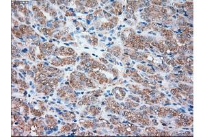 Immunohistochemical staining of paraffin-embedded Carcinoma of liver tissue using anti-SIGLEC9mouse monoclonal antibody. (SIGLEC9 Antikörper)