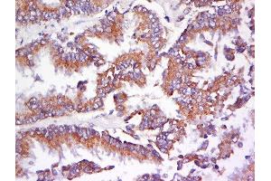 Formalin-fixed and paraffin embedded human lung carcinoma labeled with Anti-AMPK beta 1 Polyclonal Antibody, Unconjugated  at 1:200 followed by conjugation to the secondary antibody and DAB staining. (PRKAB1 Antikörper  (AA 2-100))