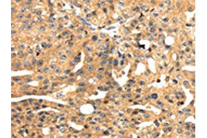 The image on the left is immunohistochemistry of paraffin-embedded Human breast cancer tissue using ABIN7131050(SH3KBP1 Antibody) at dilution 1/45, on the right is treated with fusion protein.