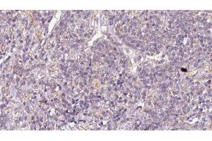 ABIN6273170 at 1/100 staining Human lymph cancer tissue by IHC-P. (STBD1 Antikörper  (N-Term))