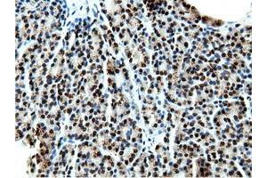 Immunohistochemical staining of paraffin-embedded Carcinoma of Human kidney tissue using anti-NT5DC1 mouse monoclonal antibody.
