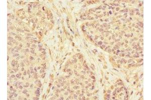Immunohistochemistry of paraffin-embedded human ovarian cancer using ABIN7157271 at dilution of 1:100