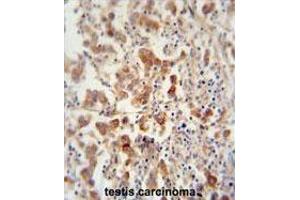 TEX13B antibody (C-term) immunohistochemistry analysis in formalin fixed and paraffin embedded human testis carcinoma followed by peroxidase conjugation of the secondary antibody and DAB staining. (TEX13B Antikörper  (C-Term))