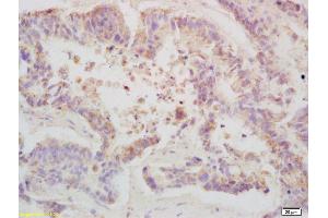 Formalin-fixed and paraffin embedded human colon carcinoma labeled with Anti-Phospho-TBK1/NAK (Ser172) Polyclonal Antibody, Unconjugated (ABIN746363) at 1:200 followed by conjugation to the secondary antibody and DAB staining (TBK1 Antikörper  (pSer172))