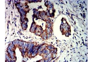 Immunohistochemical analysis of paraffin-embedded rectum cancer tissues using PAX8 mouse mAb with DAB staining. (PAX8 Antikörper  (AA 60-261))