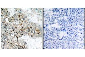 Immunohistochemical analysis of paraffin-embedded human breast carcinoma tissue using Integrin β3 (phospho-Tyr773) antibody (E011060). (Integrin beta 3 Antikörper  (pTyr773))