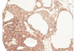 IHC-P Image Immunohistochemical analysis of paraffin-embedded Hepatocellular carcinoma Huh7 xenograft, using AGT, antibody at 1:100 dilution. (AGT Antikörper)