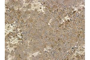 ABIN6257930 and ABIN6274821 at 1/100 staining human melanoma by IHC-P. (AGXT2L2 Antikörper  (C-Term))