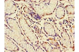 Immunohistochemistry of paraffin-embedded human gastric cancer using ABIN7160277 at dilution of 1:100 (MUC1 Antikörper  (AA 24-273))