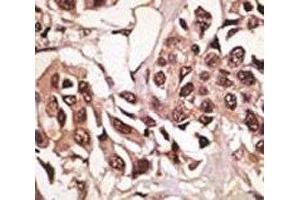 IHC analysis of FFPE human breast carcinoma tissue stained with the BMPR1A antibody (BMPR1A Antikörper  (AA 21-51))