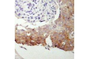 Immunohistochemical analysis of cGK 2 staining in human prostate cancer formalin fixed paraffin embedded tissue section. (PRKG2 Antikörper  (N-Term))