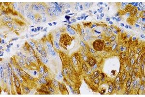 Immunohistochemistry of paraffin-embedded Human colon carcinoma using TFF1 Polyclonal Antibody at dilution of 1:200 (40x lens). (TFF1 Antikörper)