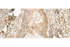 Immunohistochemistry of paraffin-embedded Human esophagus cancer tissue using ZNF397 Polyclonal Antibody at dilution of 1:80(x200) (ZNF397 Antikörper)