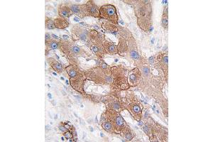 Formalin-fixed and paraffin-embedded human hepatocarcinoma tissue reacted with CYP3A5 antibody (C-term), which was peroxidase-conjugated to the secondary antibody, followed by DAB staining. (CYP3A5 Antikörper  (C-Term))