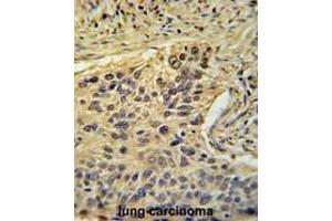 TAF2 Antibody (C-Term) immunohistochemistry analysis in formalin fixed and paraffin embedded human lung carcinoma followed by peroxidase conjugation of the secondary antibody and DAB staining. (TAF2 Antikörper  (C-Term))