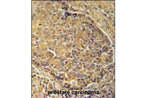 IGSF1 antibody immunohistochemistry analysis in formalin fixed and paraffin embedded human prostate carcinoma followed by peroxidase conjugation of the secondary antibody and DAB staining. (IGSF1 Antikörper  (C-Term))