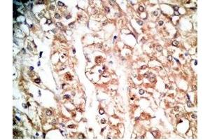 Human kidney cancer tissue was stained by rabbit Anti-BNP-45 (Mouse) Antiserum (BNP-45 Antikörper  (AA 51-95))