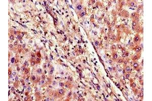 Immunohistochemistry of paraffin-embedded human liver tissue using ABIN7170291 at dilution of 1:100 (SLCO1B3 Antikörper  (AA 648-695))