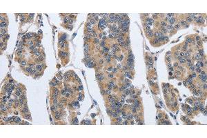Immunohistochemistry of paraffin-embedded Human breast cancer using IPO7 Polyclonal Antibody at dilution of 1:40 (IPO7 Antikörper)